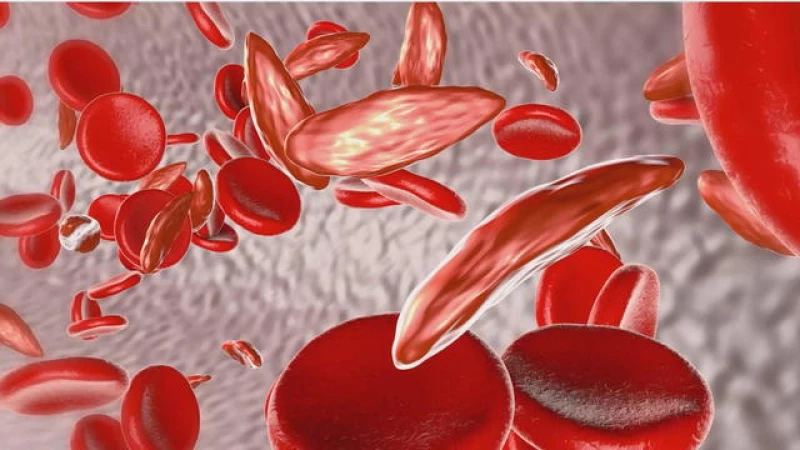 Historic Breakthrough: U.K. Greenlights Groundbreaking Gene Therapy for Sickle Cell and Thalassemia