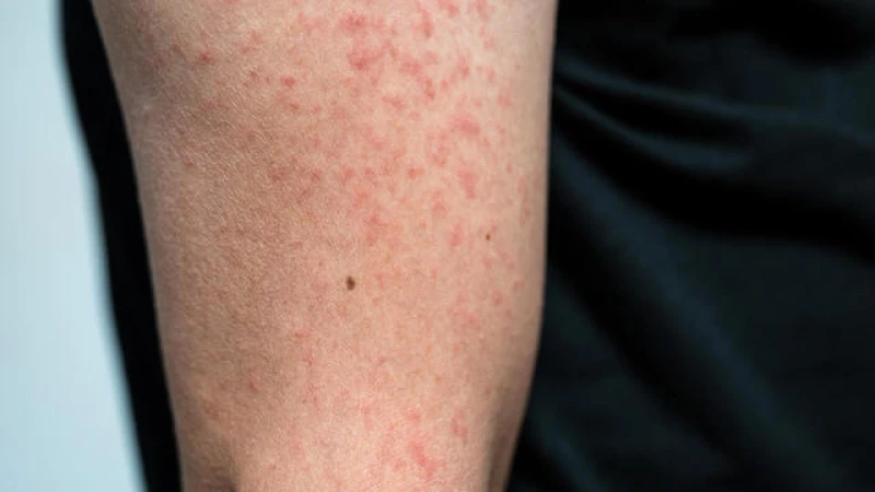 Measles Outbreak Spreads Across 3 States Following Florida Travel