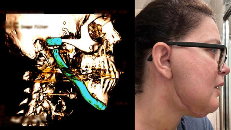 Unveiling the Nightmare of TMJ: Endless Pain, Metal Jaws, and Failed Remedies